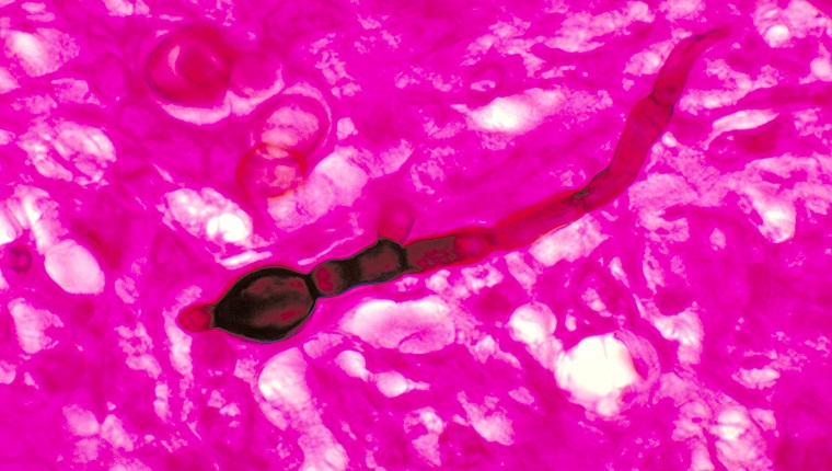 Diese mikroskopische Aufnahme zeigt histopathologische Veränderungen, die das Vorhandensein des Pilzmittels Blastomyces dermatitidis, 1978, aufzeigen. Blastomykose, verursacht durch Blastomyces dermatitidis, ist eine grippeähnliche Erkrankung mit Fieber, Schüttelfrost, produktivem Husten, Myalgie, Arthralgie und pleuritischen Brustschmerzen. Es gibt 1-2 Fälle pro 100.000 Menschen in Gebieten mit endemischen Krankheiten. Mit freundlicher Genehmigung von CDC / Dr. Libero Ajello. (Foto von Smith Collection / Gado / Getty Images).